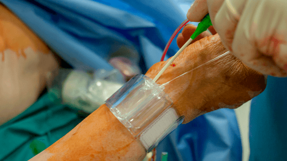    TENDERA: Comparación de Oclusión Radial entre Acceso Distal y Convencional para Intervenciones Coronarias | Grupo i2